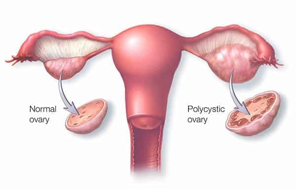 Symptoms of PCOS