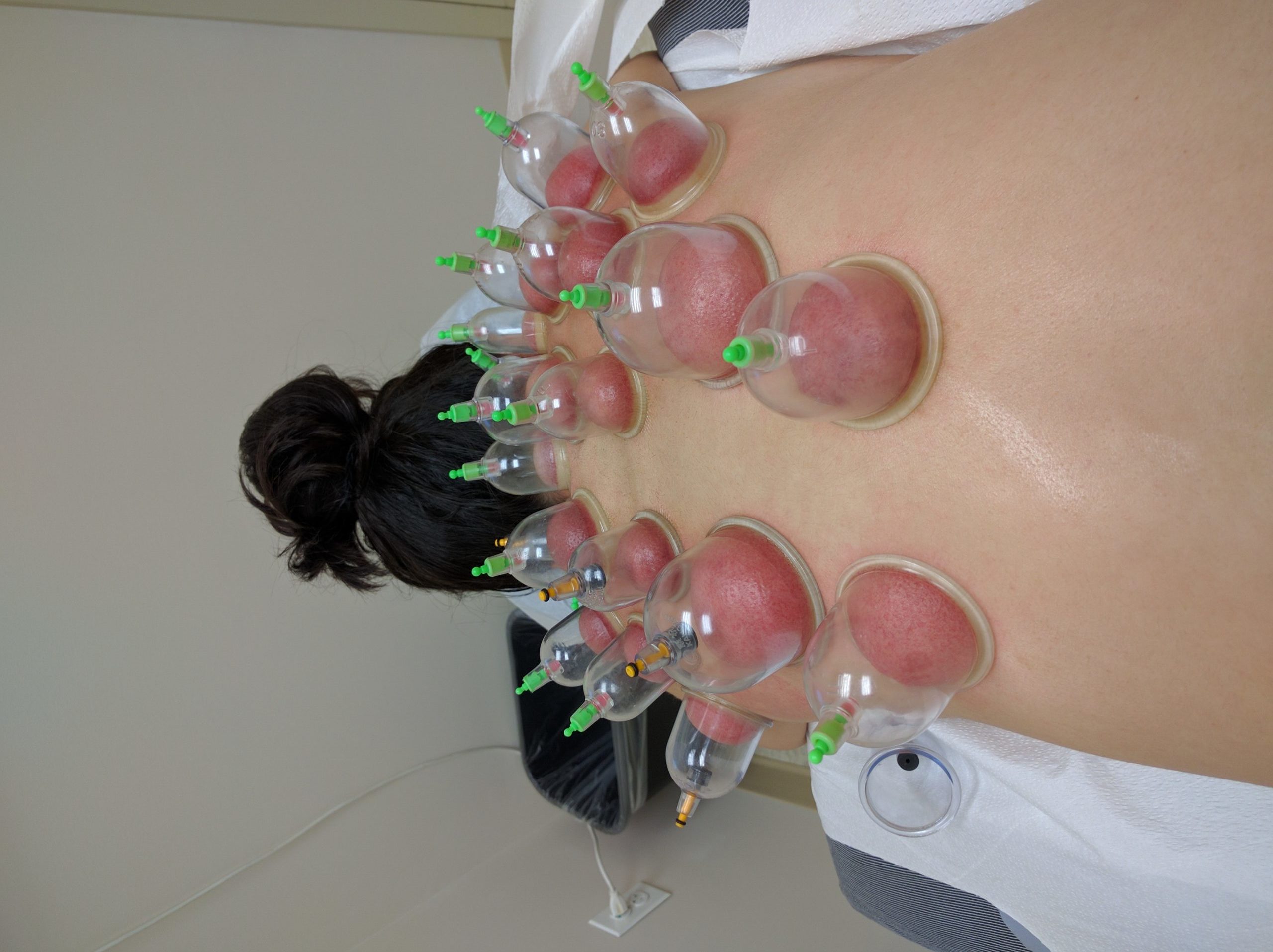 Cupping by Dr. Tsan