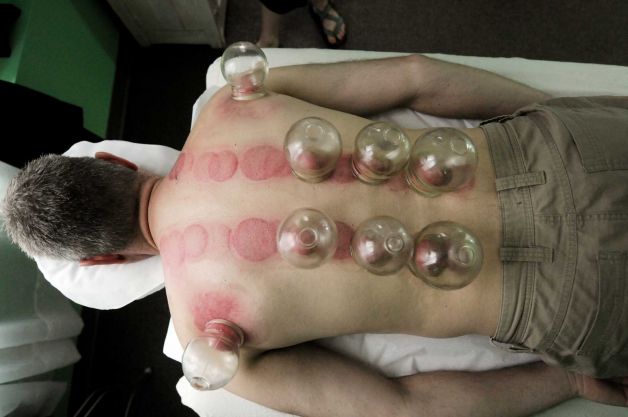 Cupping Therapy Near Me - Traditional Chinese Medicine Clinic