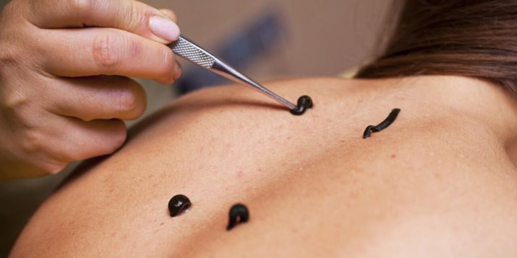 Leech Therapy Near Me