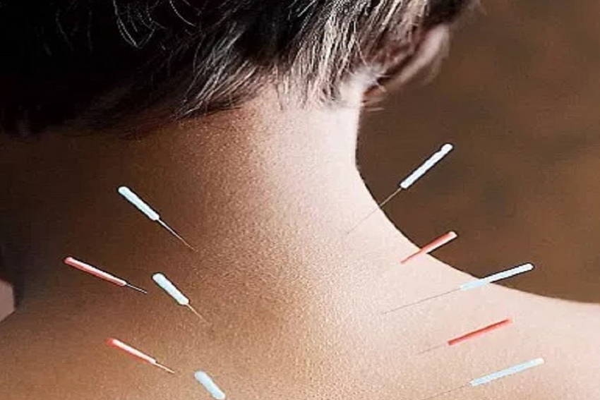 Acupuncture for neck pain