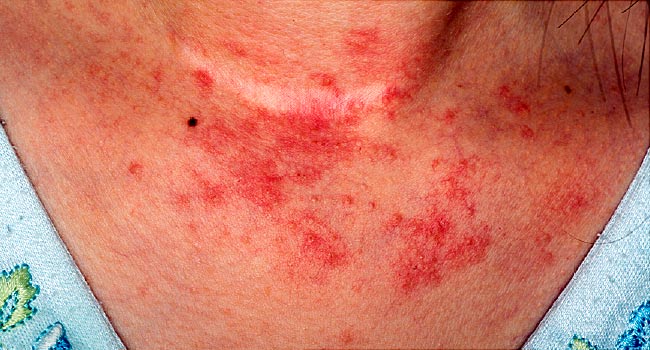 home remedies for eczema