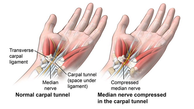 Pathology of carpal Tunnel Syndome and Natural treatment for carpal tunnel syndrome