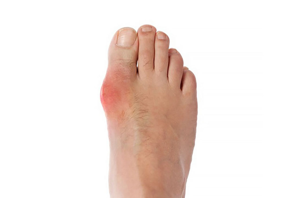 Homeopathic Treatment in Acute Gout