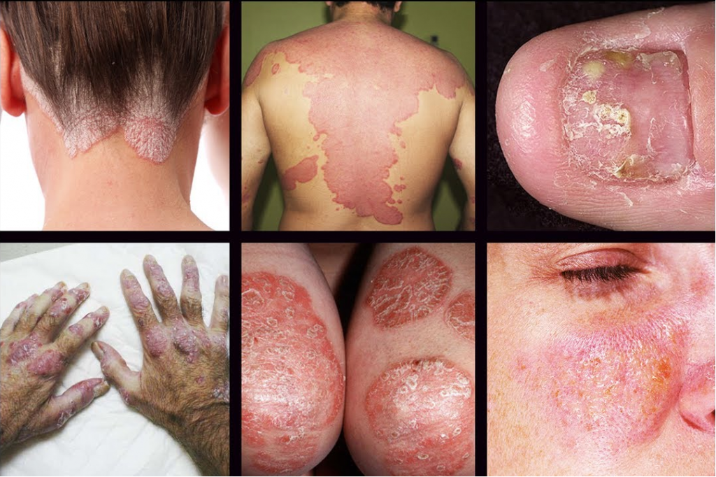 home remedies for psoriasis