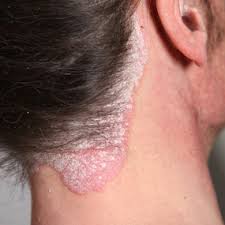 home remedies for psoriasis on scalp