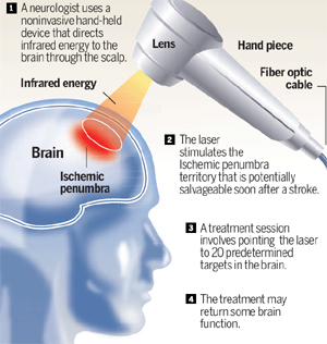 Natural Stroke Recovery Treatment