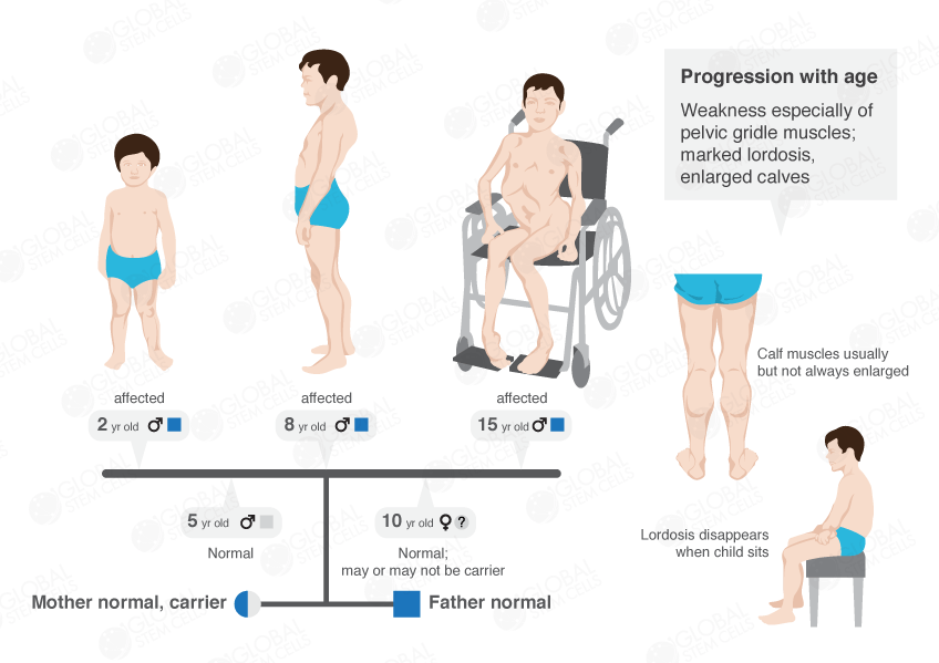 natural treatment for muscular dystrophy