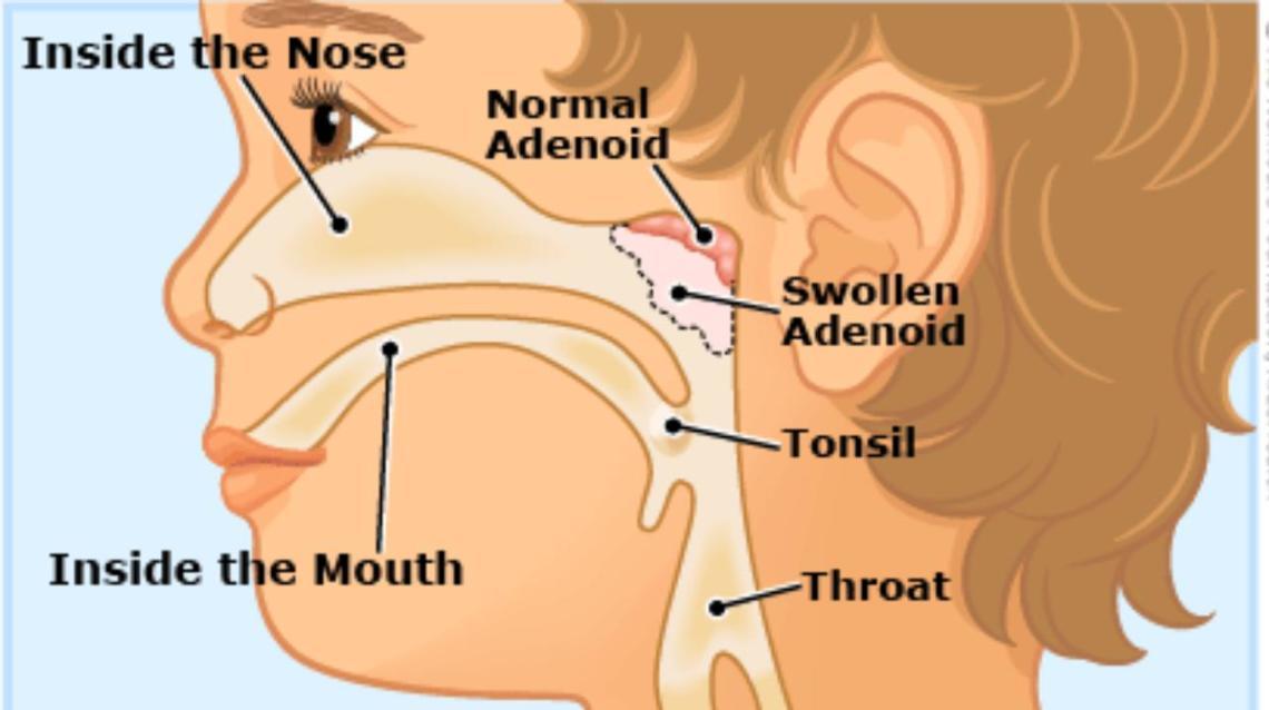 Enlarged adenoids and Natural treatment for adenoids