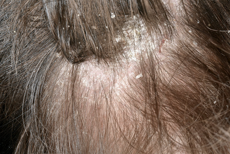 Dandruff In Seborrheic Dermatitis Philadelphia Holistic Clinic