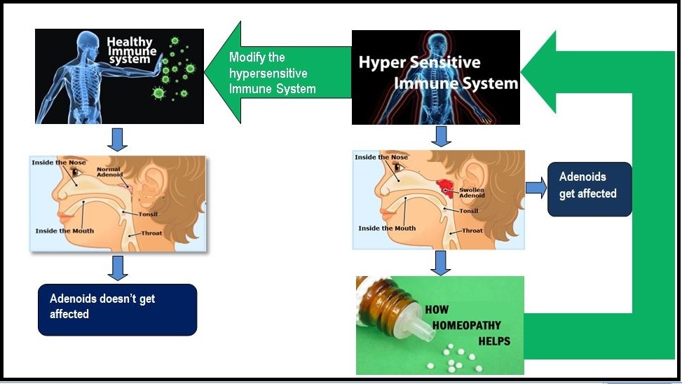 Homeopathy for adenoids - #1 natural treatment for adenoids