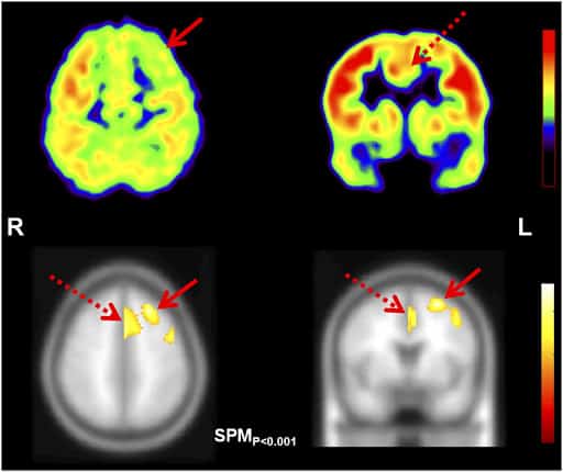 Epilepsy - Pathology