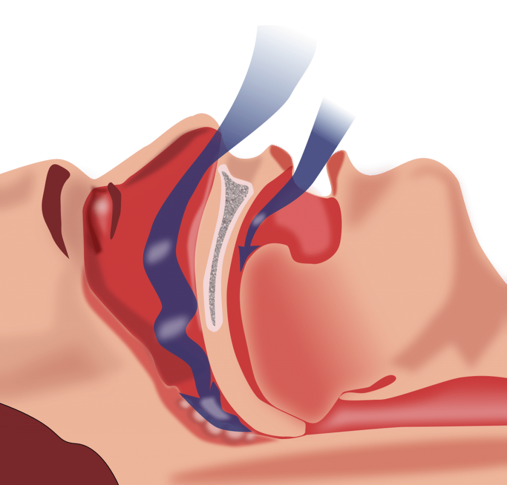 Sleep Apnea - Snoring