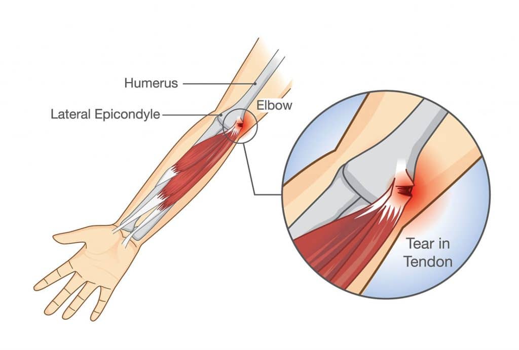 Home remedies for tennis elbow Philadelphia Holistic Clinic Dr. Tsan