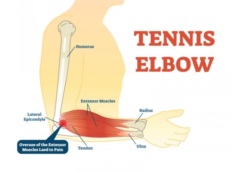 Home remedies for tennis elbow Philadelphia Holistic Clinic Dr. Tsan