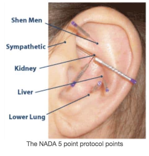 Acupuncture - ancient Chinese treatment for addictions, alcoholism and smoking