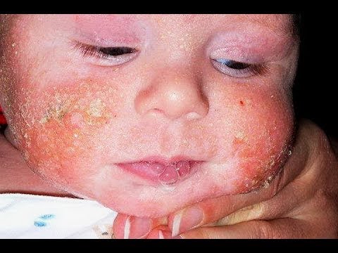 Baby eczema on face