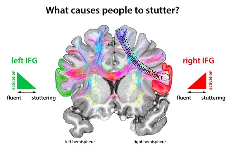 What Causes A Stutter To Develop