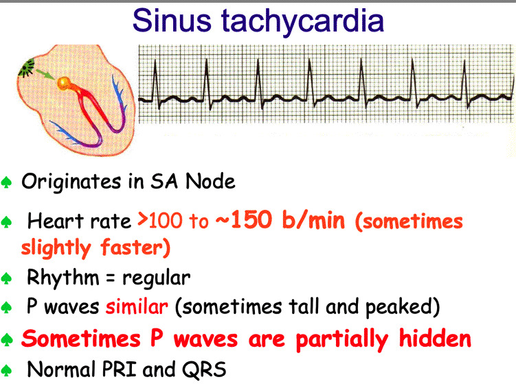 Tachycardia