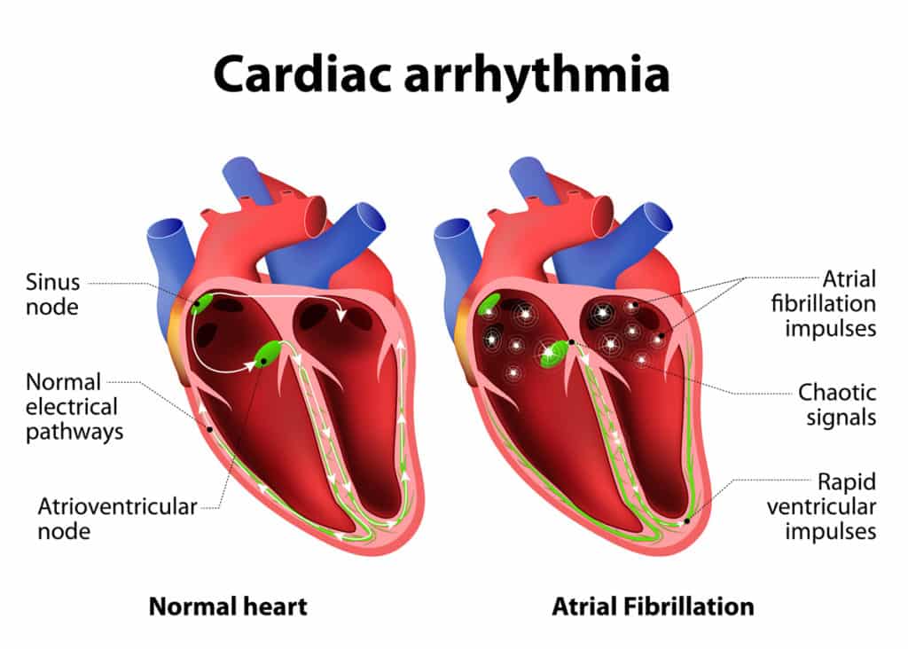 Natural Treatment of Arrhythmia