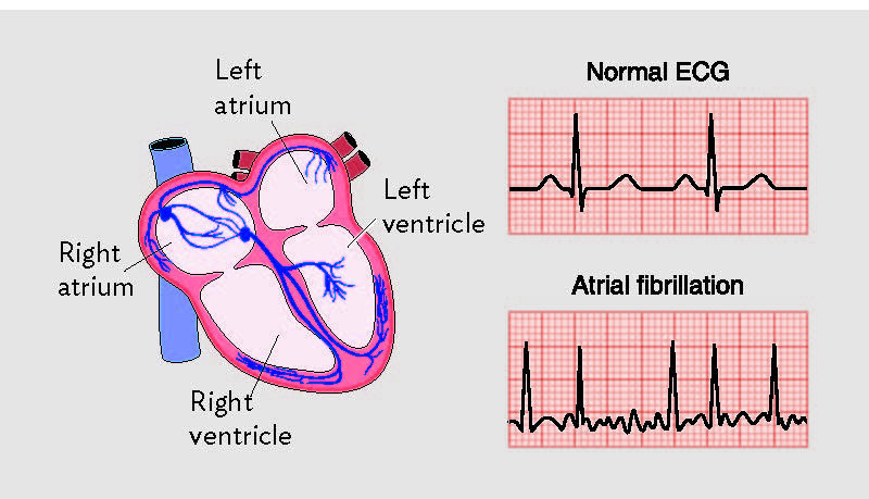 AFIB - Treatment for Arrhythmia