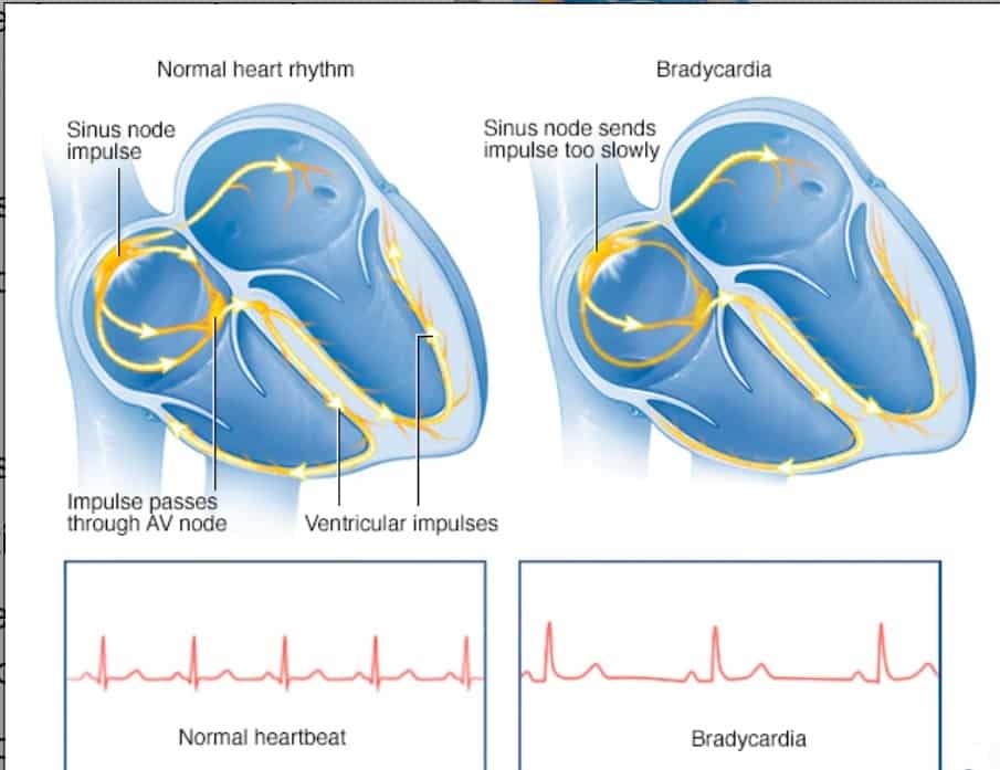 Arrhythmia Bradicardia - Philadelphia Holistic Clinic