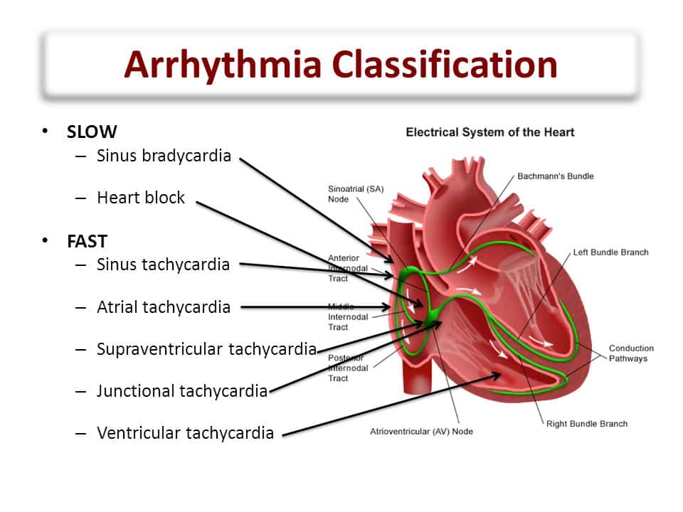 cardiac-arrhythmias-signs-and-symptoms