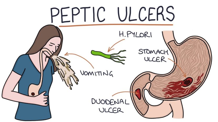 How Long Do Peptic Ulcers Take To Heal