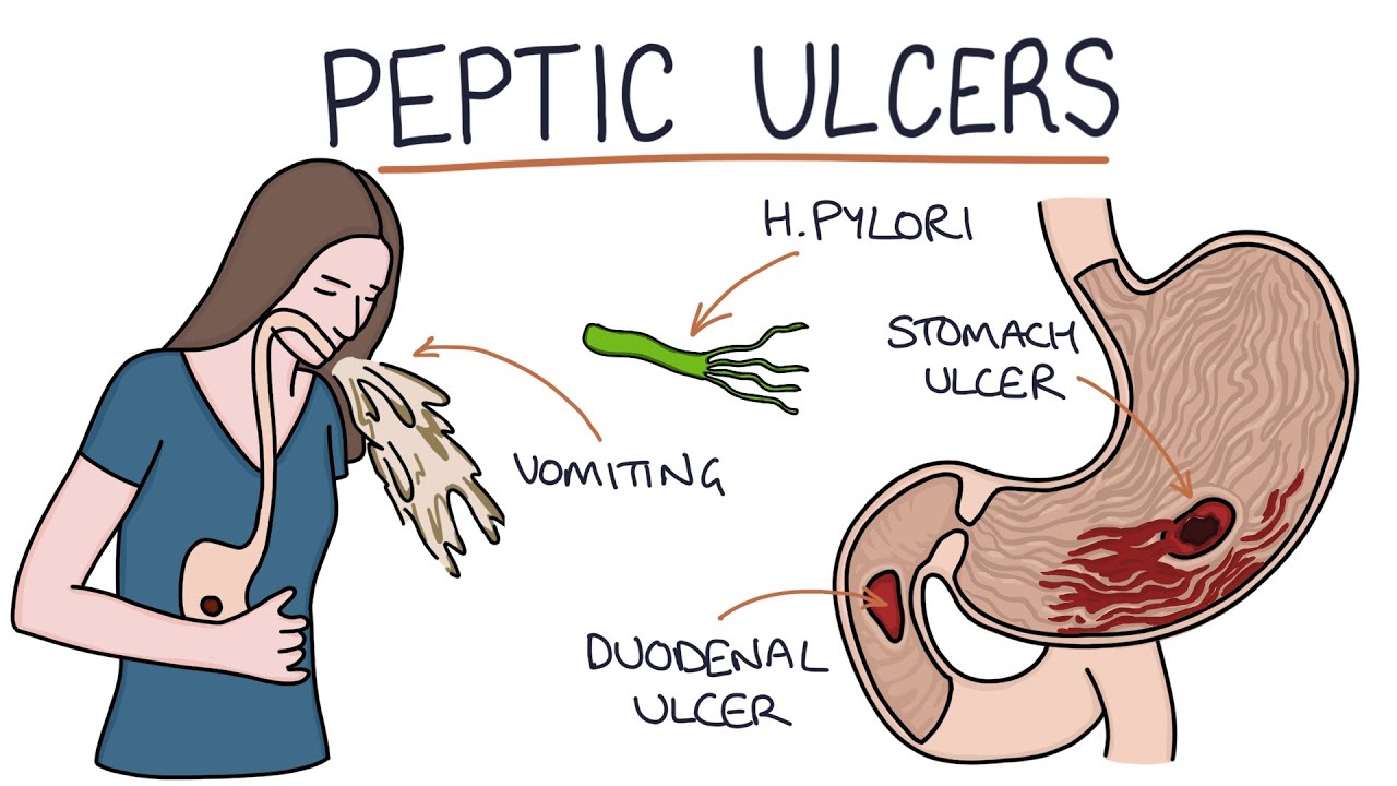 pathology-gastritis-peptic-ulcer-disease-ditki-medical