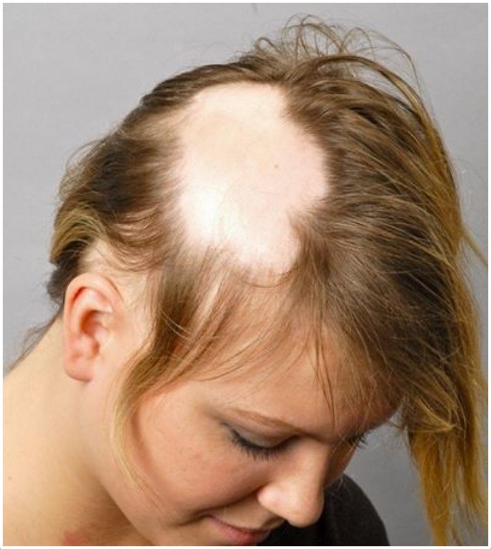 Alopecia Areata - natural treatment for alopecia areata