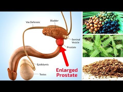 Home remedies for prostate enlargement