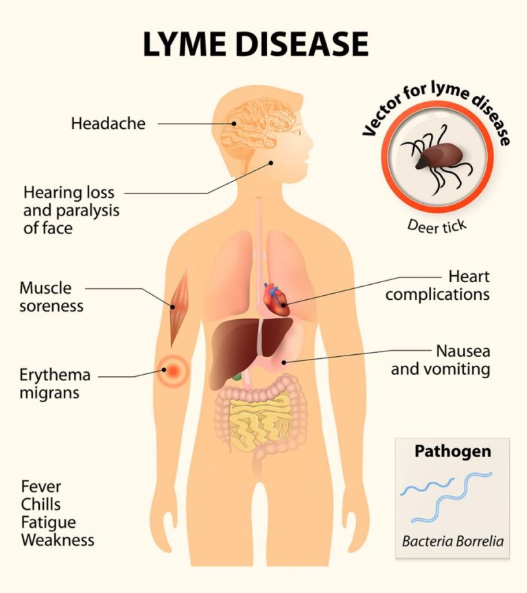 Treatment for Lyme Disease Philadelphia Holistic Clinic Dr. Victor Tsan