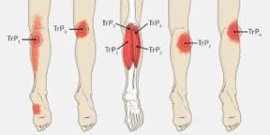 Restless leg syndrome acupuncture - Philadelphia Holistic  