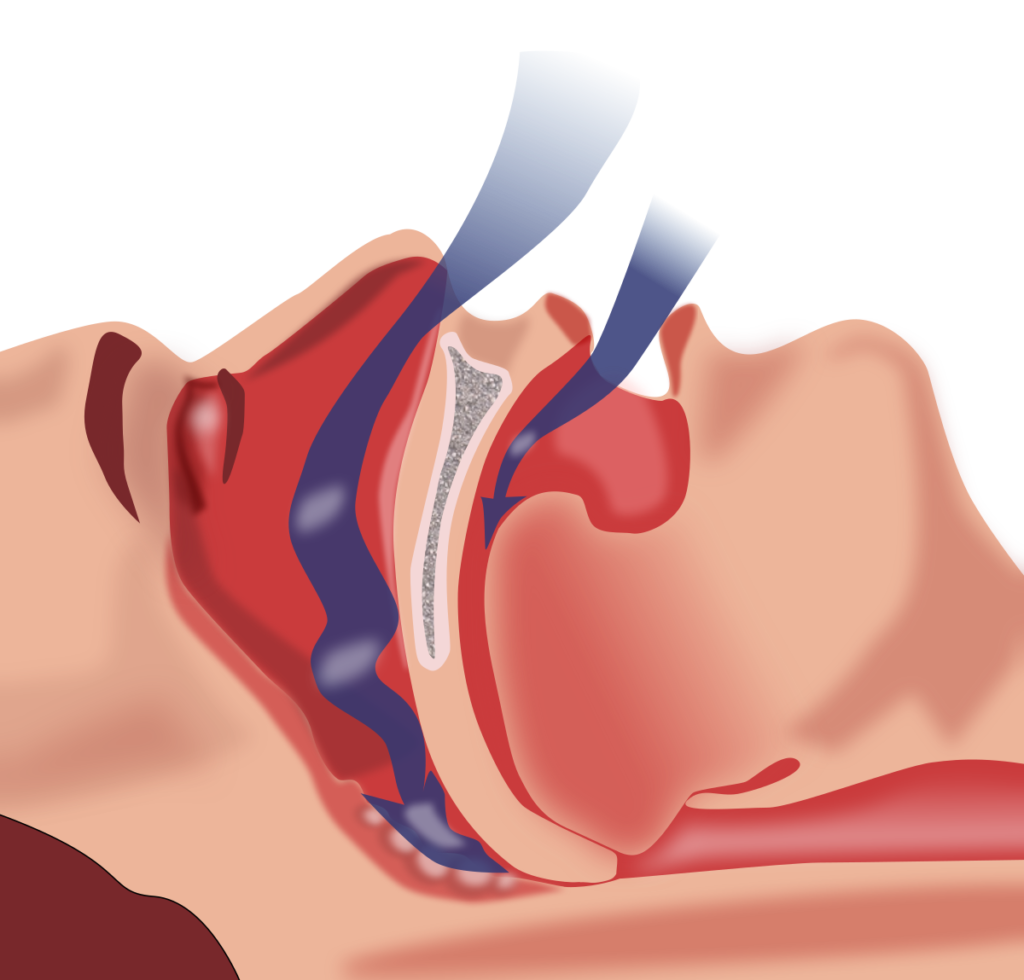 Sleep apnea