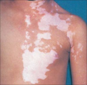 Vitiligo - loss of pigment in skin