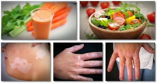 Vitiligo home remedies - Philadelphia Holistic Clinic