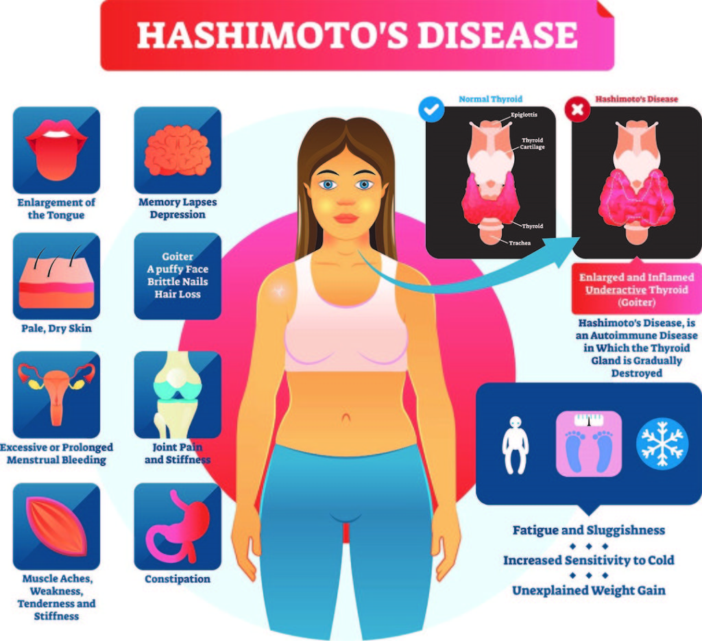 hashimotos-disease-philadelphia-holistic-clinic