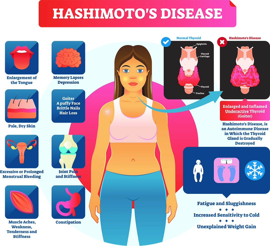 Treatment for Hashimoto's Disease Philadelphia Holistic