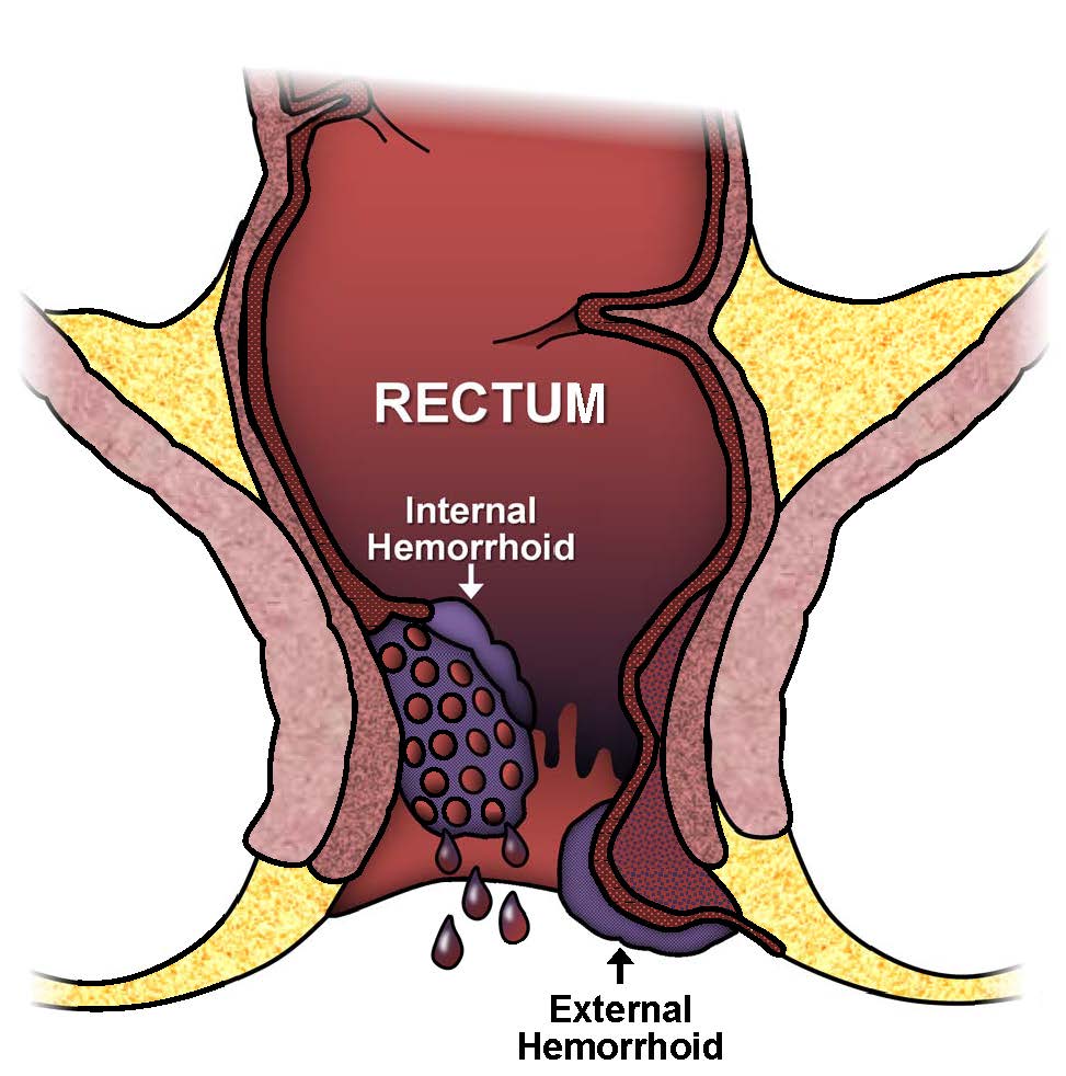 Hemorrhoids