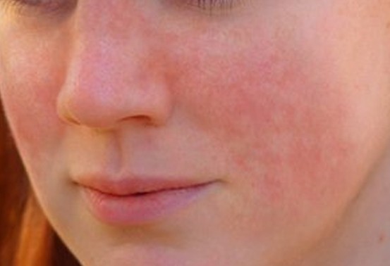 Natural Treatment for Lupus