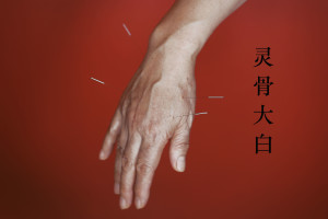 Acupuncture for Rheumatoid Arthritis