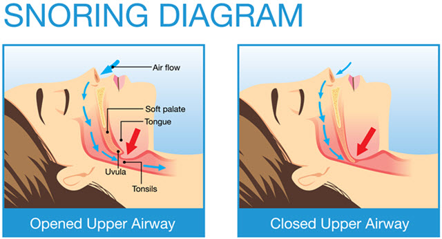 What is snoring