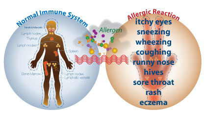 Allergy Symptoms