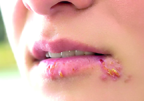 Cold sores on a lip