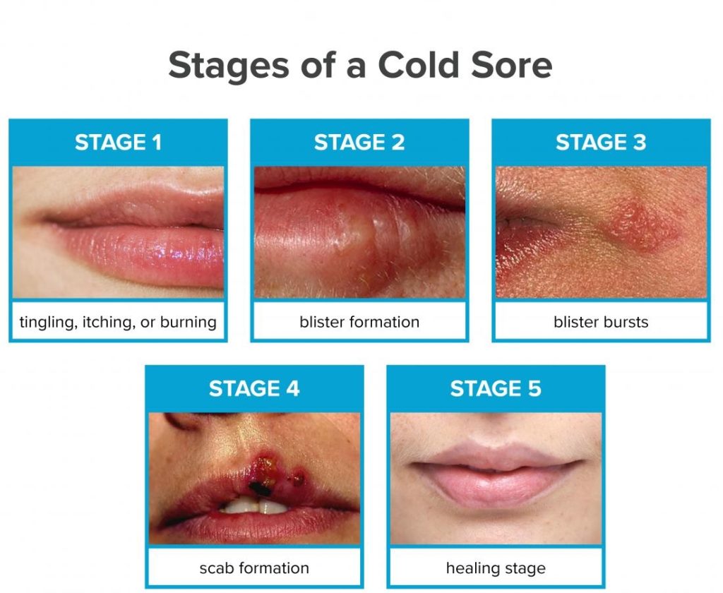 treatment for a cold sore on the lip