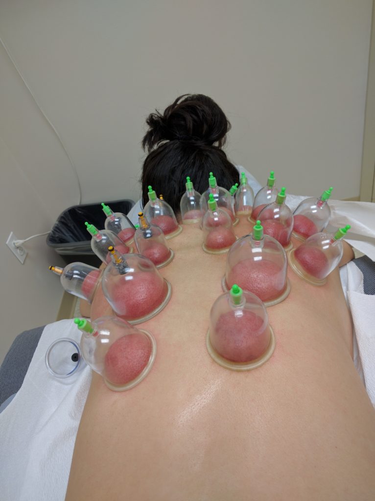 Cupping for pneumonia