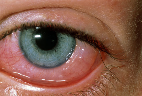 Treatment for Eye Allergies