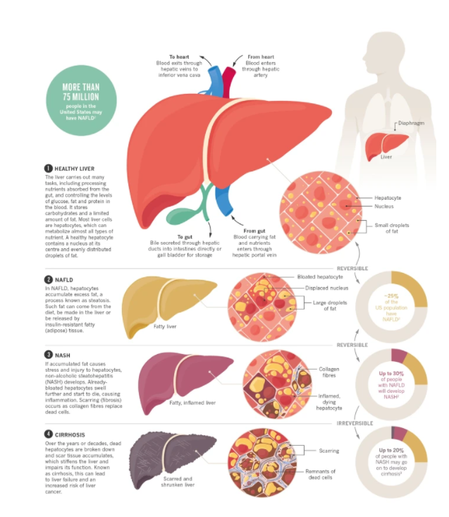 Natural treatment for fatty liver disease