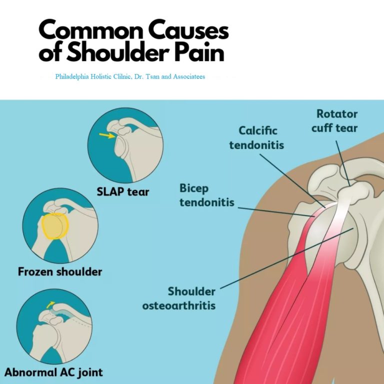 Treatment For Frozen Shoulder - Philadelphia Holistic Clinic - Dr Tsan ...