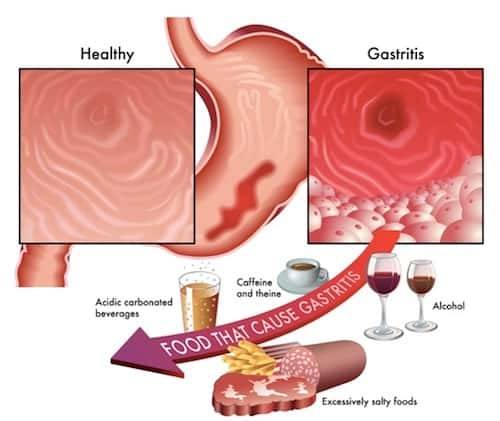 treatment-for-gastritis-philadelphia-holistic-clinic-dr-tsan